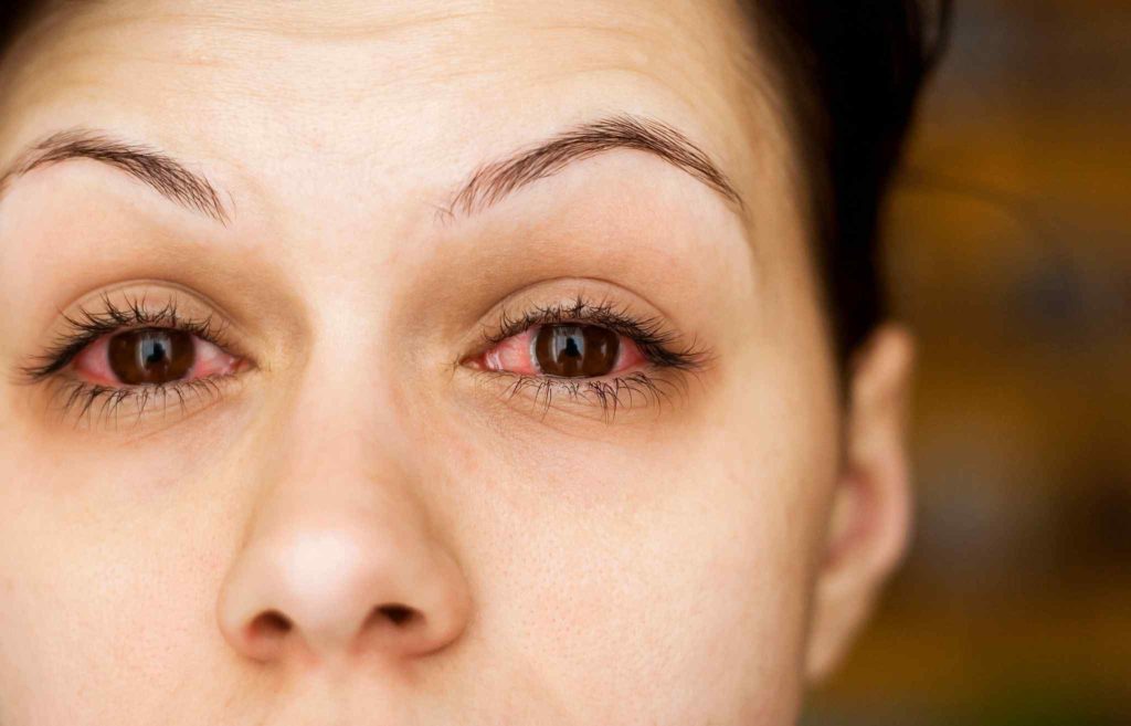 10-causes-of-dry-eyes-and-how-to-treat-it